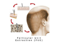 what is FUE treatment